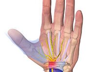 Ilustración de los nervios de la mano. Se muestran los nervios para explicar el síndrome del túnel carpiano